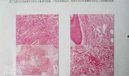 脑科肿瘤爆料案例最新,最新爆料揭示治疗挑战与希望